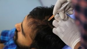 hair loss treatment for men