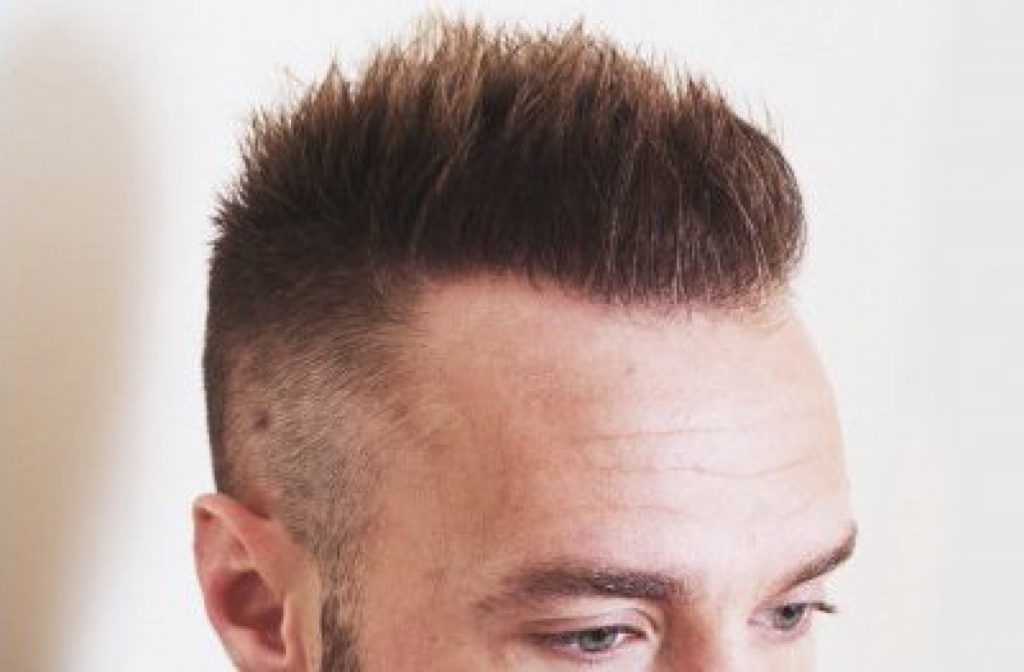 hair transplant